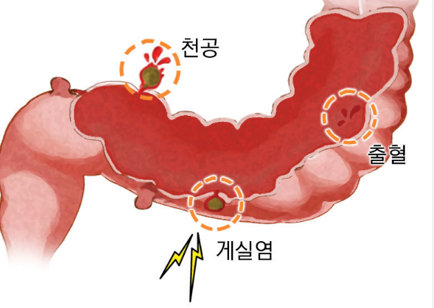 게실염 증상과 원인 치료 합병증 소화기 질환 정보