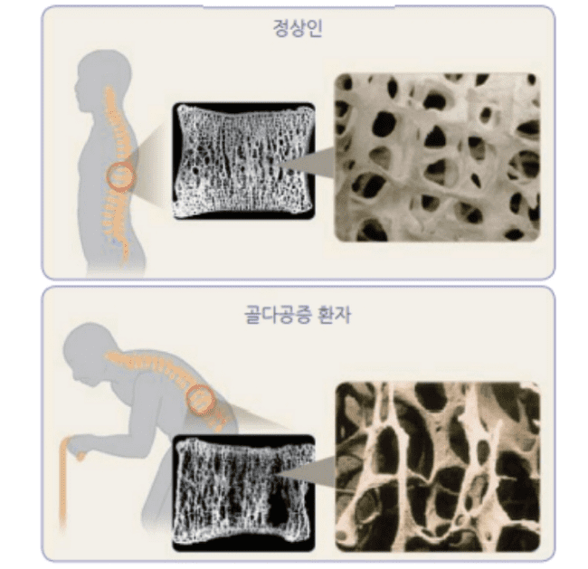 정상 뼈와 골다공증 뼈의 구조 비교