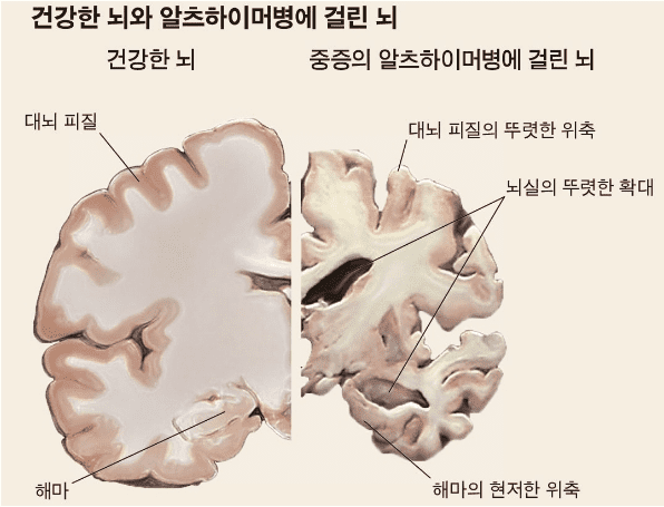알츠하이머병 환자의 뇌 위축을 보여주는 영상