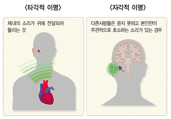 자각적 이명과 타각적 이명의 종류를 구분한 이미지