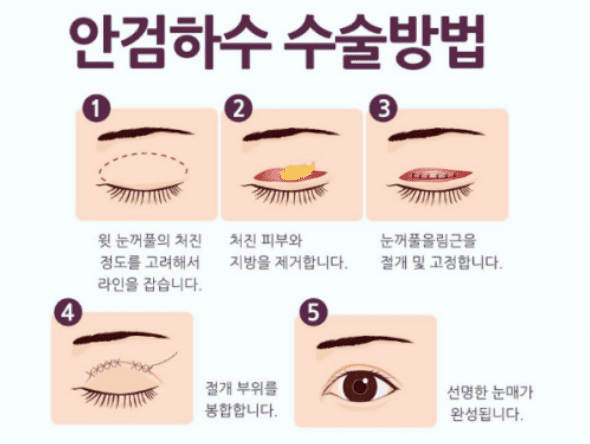 안검하수 수술 방법을 설명하는 도해