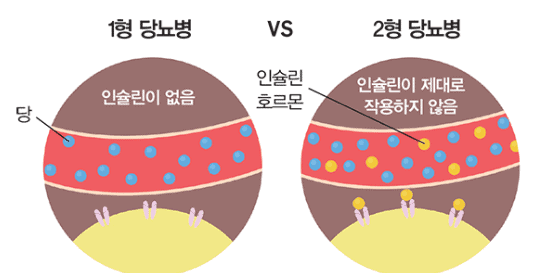 1형 당뇨와 2형 당뇨의 차이를 보여주는 그림