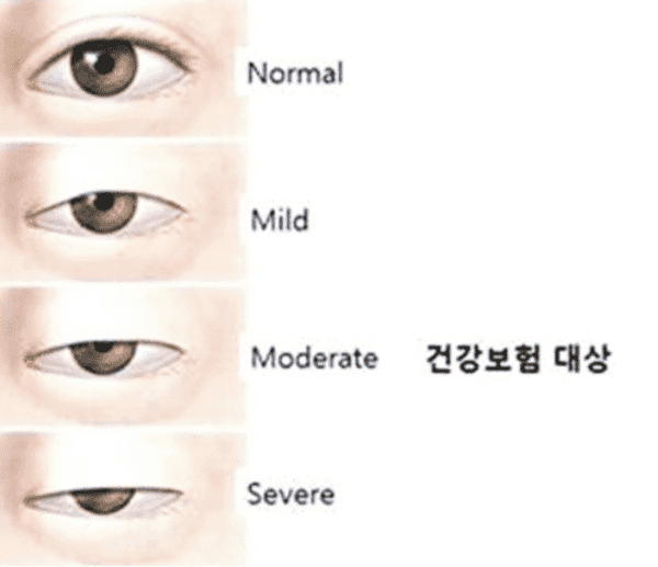 안검하수 정도에 따른 보험 적용 기준을 보여주는 이미지