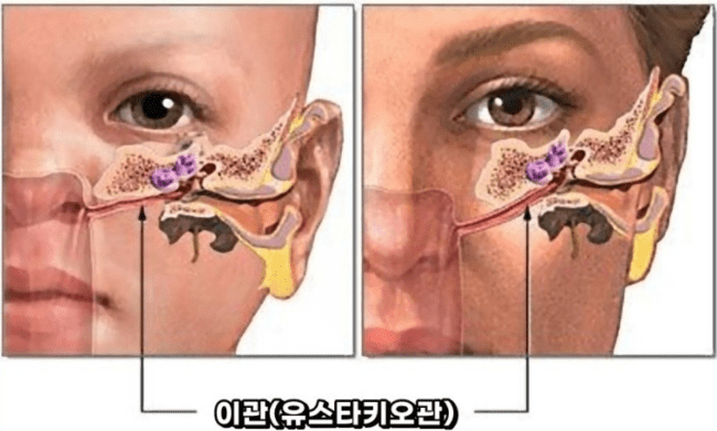 이관 기능 이상으로 생기는 이명을 설명하는 이미지