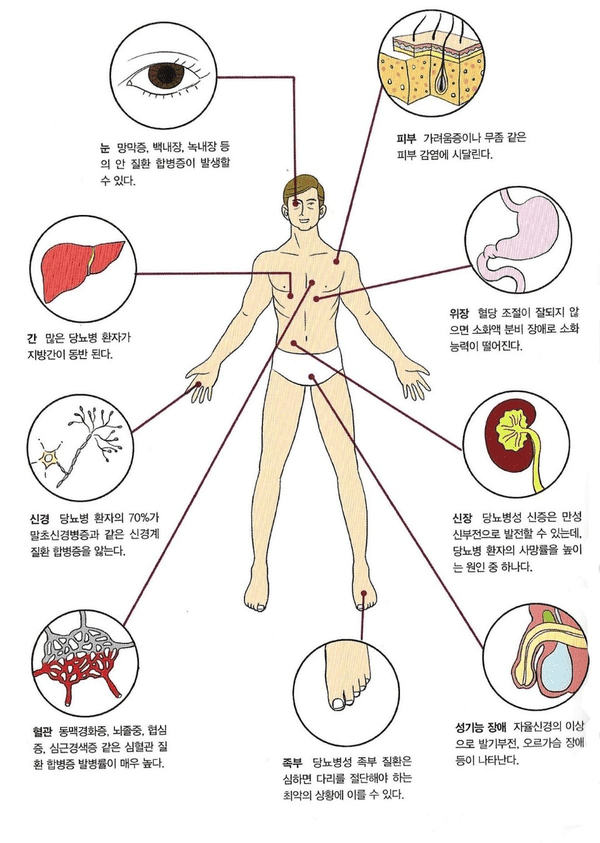 당뇨병으로 생길 수 있는 합병증 정리